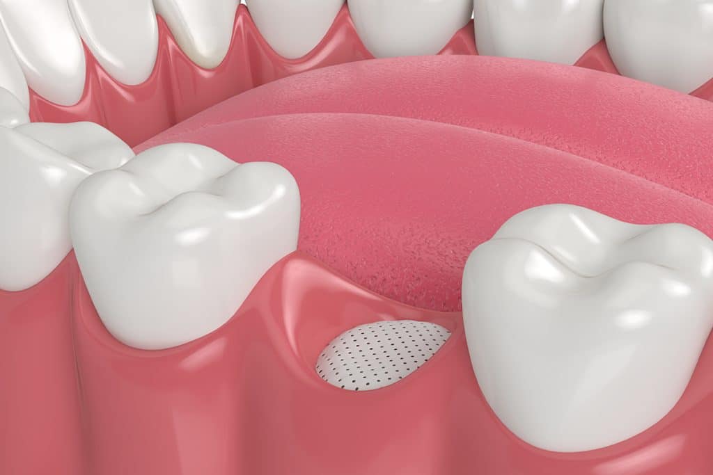 How is Dental Bone Grafting Done?